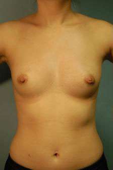Breast Augmentation Before