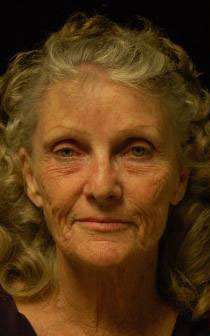 Facial Fat Transfer Before and After Photos