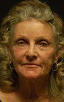 Facial Fat Transfer Before and After Photos