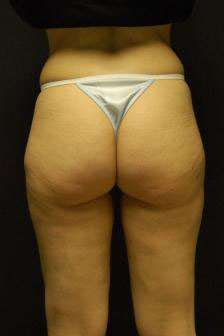 Liposuction After